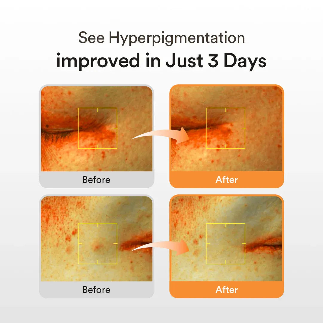 Abib Glutathiosome Dark Spot Serum Vita Drop – Fades Dark Spots & Hyperpigmentation in 3 Days