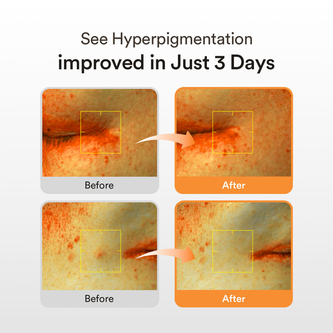 Abib Glutathiosome Dark Spot Serum Vita Drop – Fades Dark Spots & Hyperpigmentation in 3 Days