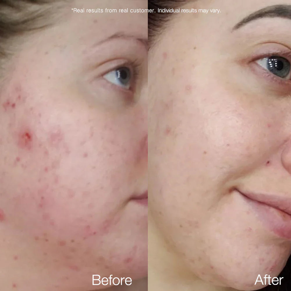 APRILSKIN Carrotene Clarifying Serum — clarifying serum that balances and clears skin