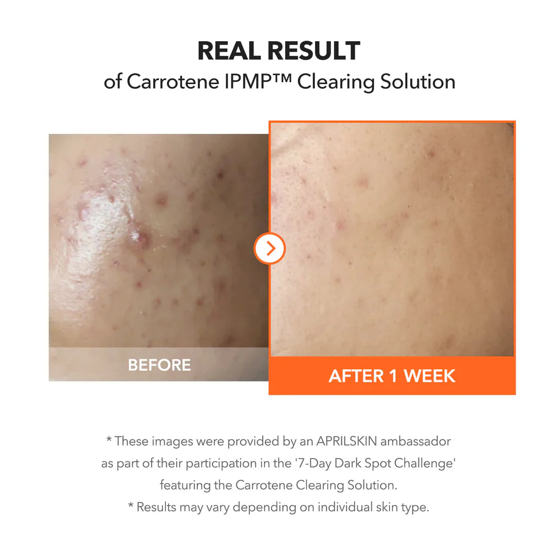 APRILSKIN Carrotene IPMP Clearing Solution gentle leave-on treatment
