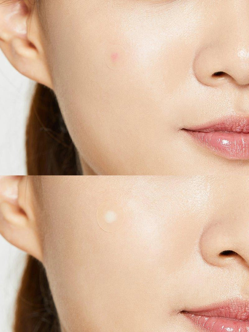 COSRX Acne Pimple Master — how to use: apply a clean patch over the blemish on dry skin