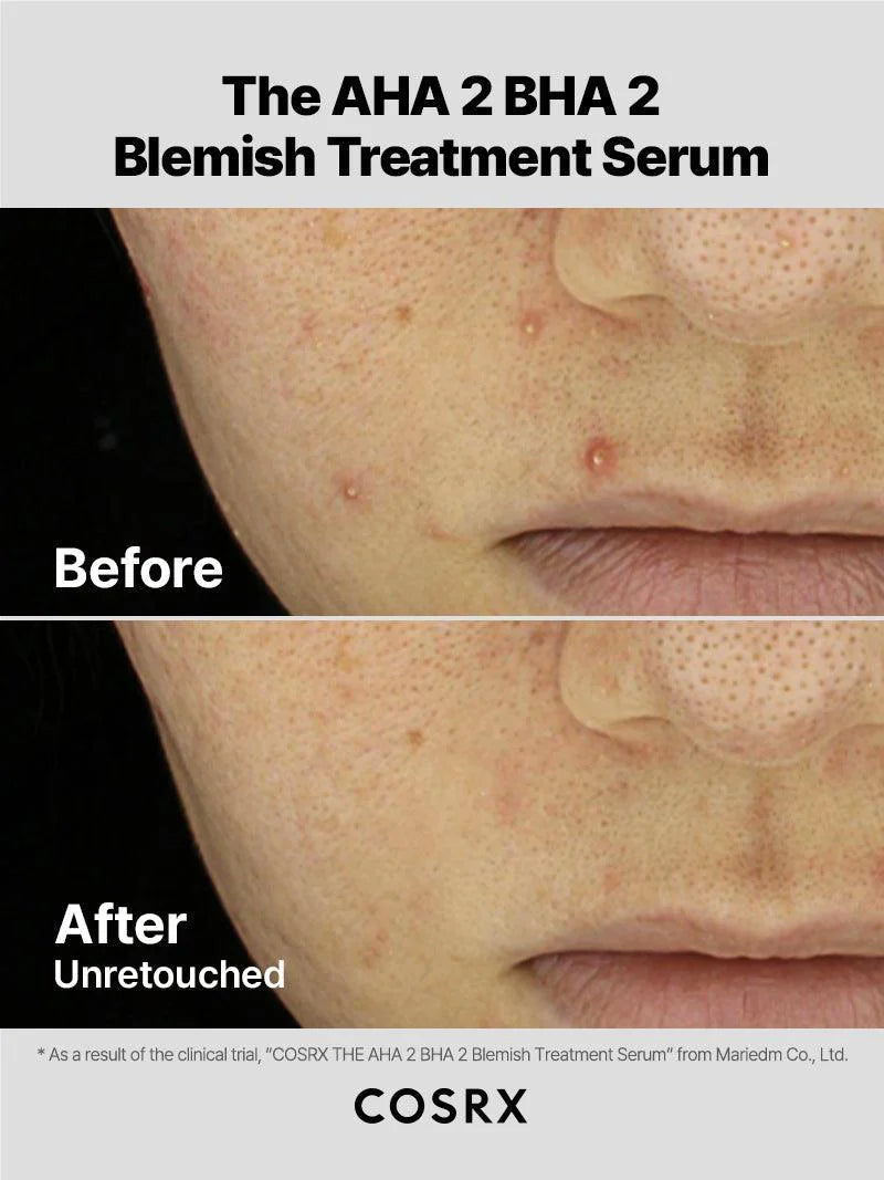 COSRX The AHA 2 BHA 2 Blemish Treatment Serum — gently exfoliates for smoother, clearer skin