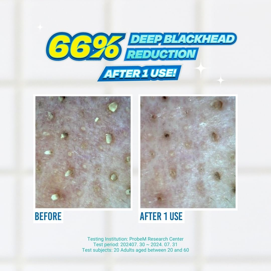 Targets stubborn blackheads around the nose