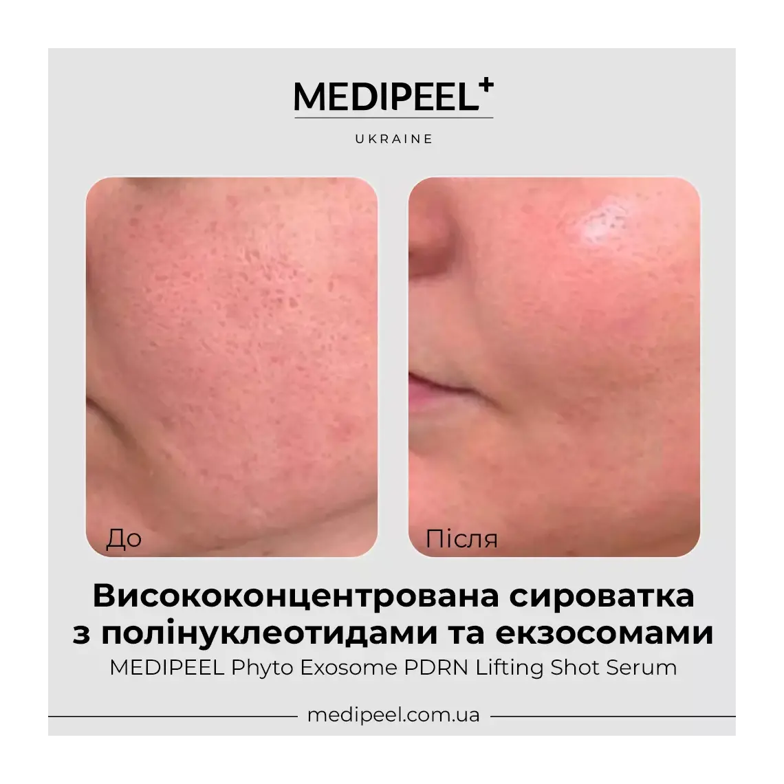 MEDI-PEEL Phyto Exosome PDRN Lifting Shot Serum — helps firm and tighten for a sculpted look