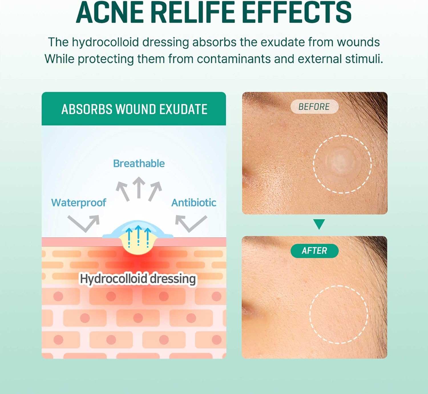 SOME BY MI 30 Days Miracle Clear Spot Patch — hydrocolloid absorbs impurities