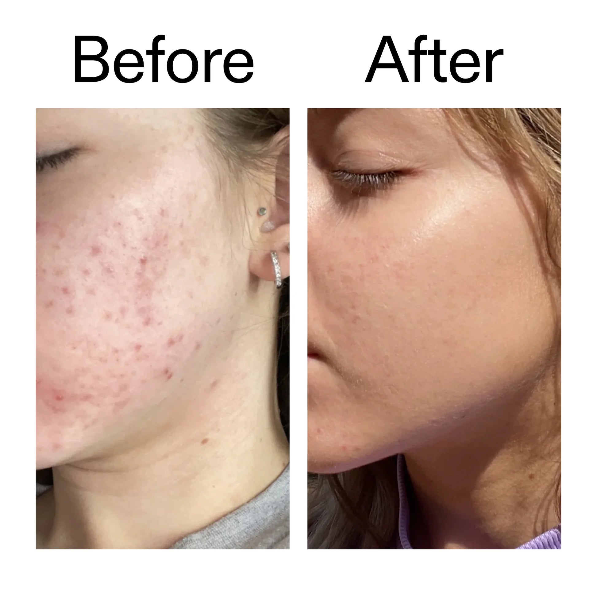 Apply morning and night after cleansing