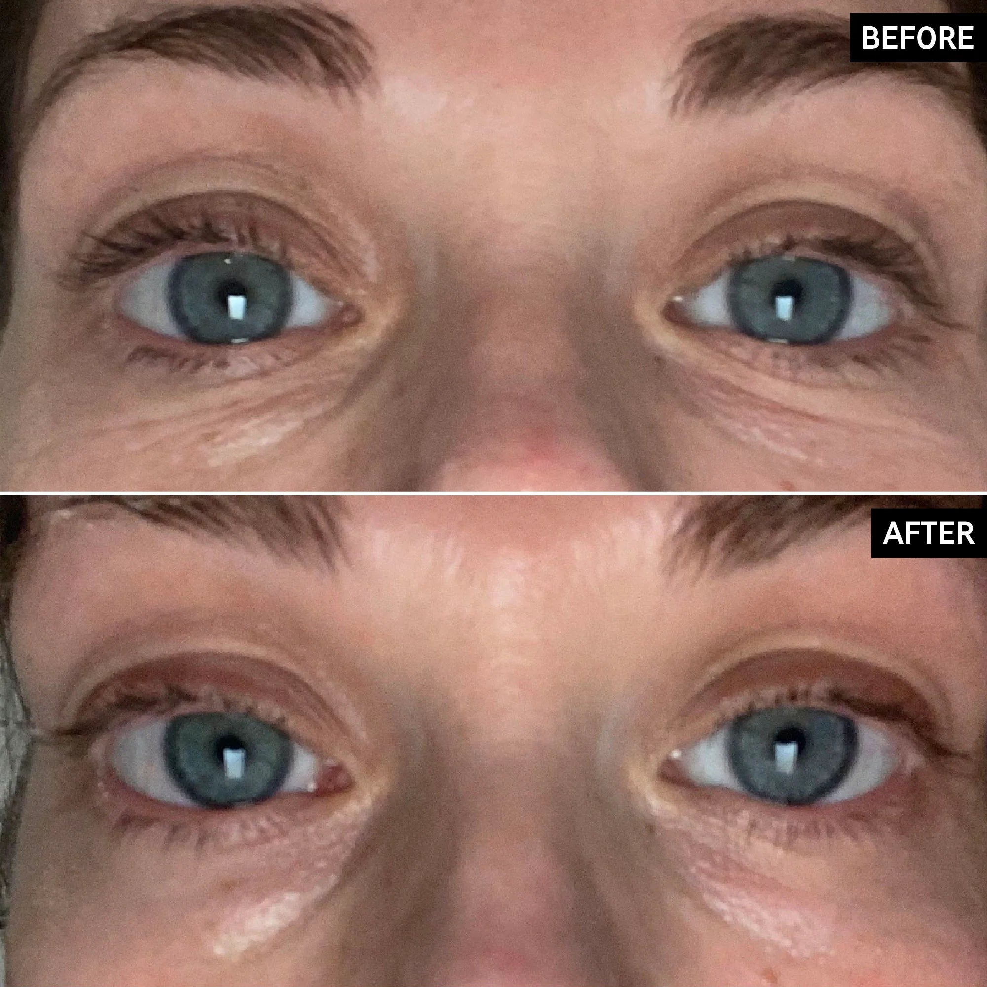 Targets multiple signs of eye-area aging